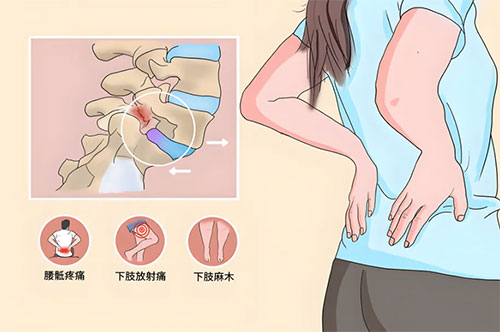 打工人的腰椎疾?。貉甸g盤突出知多少？