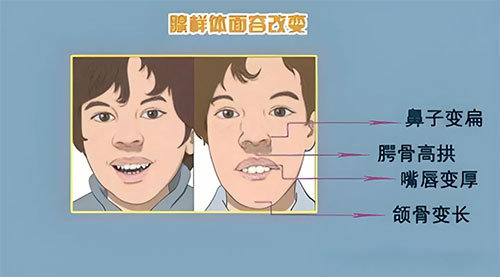 【惠民科普】急急急！小孩腺樣體肥大，究竟要不要切除？
